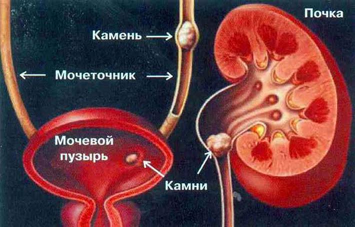 Диета при камнях в почках